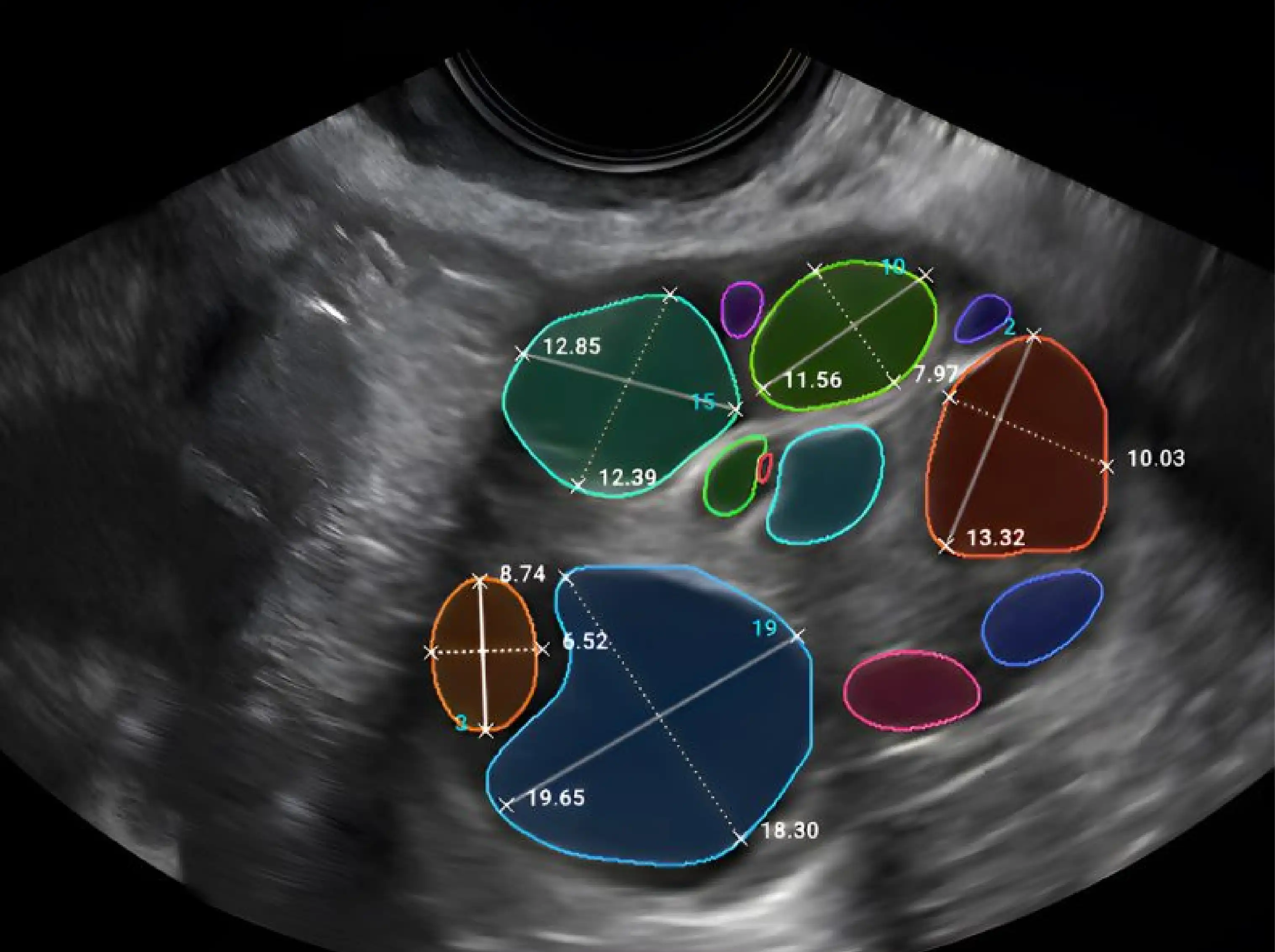 In Vitro Fertilization (IVF) | Jordan